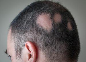 Alopecia Areata Male