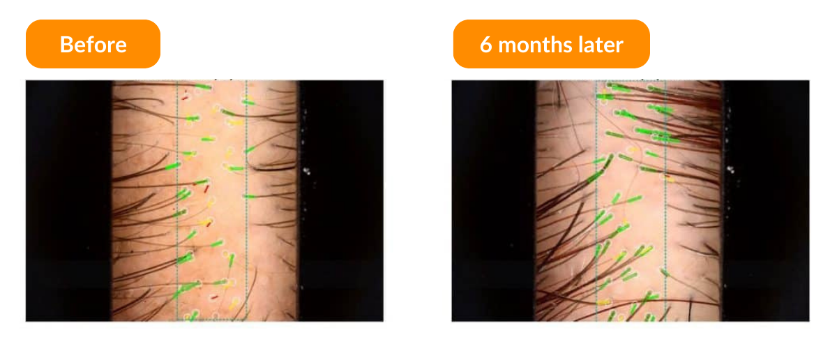 advanced follicle direct before after