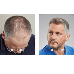 Darren Gough - Before & After Hair Loss